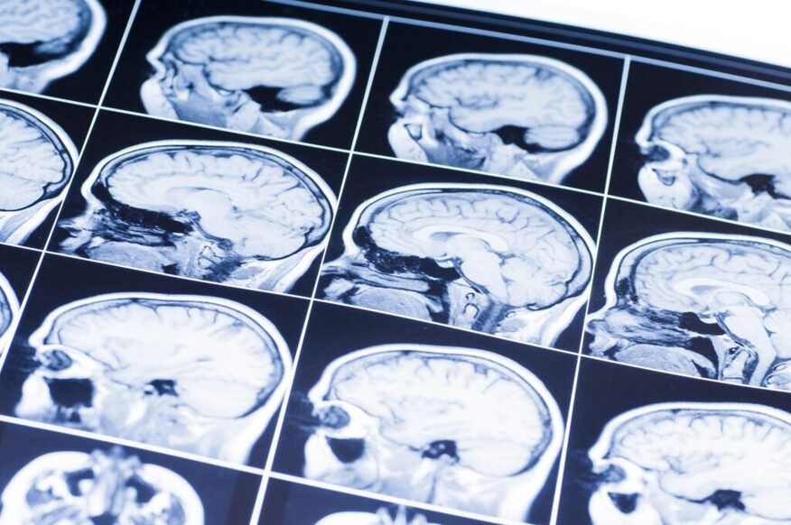 brain injury lawyer in San Luis Obispo